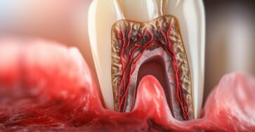 Tooth abscess